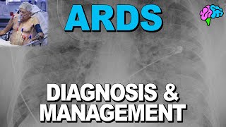 Diagnosis and Management of Acute Respiratory Distress Syndrome ARDS [upl. by Grevera]