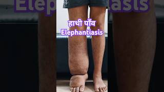 हाथी पांव Elephantiasis ये कौन सी बीमारी है filaria [upl. by Yliram665]