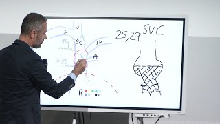 Heterotopic tricuspid valves to who when and how  EuroPCR 2024 [upl. by Oilla326]