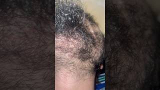 Beard hair removal removingingrown hairissue satisfying ingrownhairremoval hair ingrown [upl. by Territus]