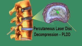 PLDD  Percutaneous Laser Disc Decompression [upl. by Airpac]