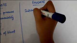 Pleural Effusion  EXUDATE vs TRANSUDATE  Lights criteria [upl. by Siuqaj]