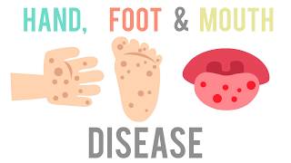 Hand Foot amp Mouth Disease WHAT YOU SHOULD KNOW  KPJ Ipoh [upl. by Irap]