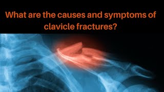 What are the common causes and symptoms of a clavicle fracture [upl. by Uahsoj]