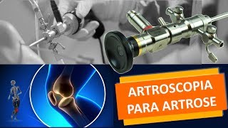 ARTROSCOPIA PARA ARTROSE NO JOELHO [upl. by Naid]