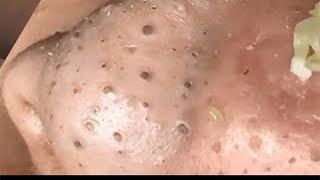 Acne treatment Blackhead remove with Spa Loan [upl. by Nahtan149]