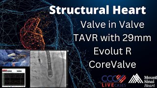 Valve in Valve TAVR with 29mm Evolut R CoreValve  January 8 2019 [upl. by Farro832]