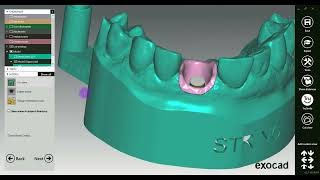 How to design a Digital Implant Model in exocad [upl. by Aivirt29]