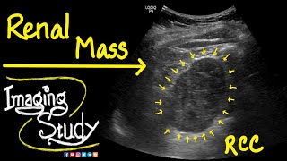 Renal Cell Carcinoma  RCC  Ultrasound  Doppler  Case 41 [upl. by Ettenan]