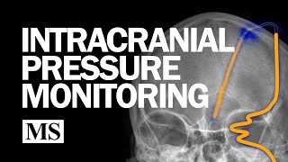 External Ventricular Drainage and Intracranial Pressure Monitoring [upl. by Clarkin]