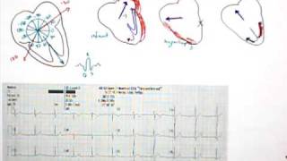 12 Lead EKG Part 5 QRS Axis [upl. by Buller]