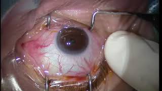 Lucentis Intravitreal Injection Technique for maculopathy [upl. by Laux365]