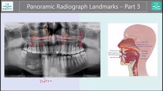 Simple Panoramic Radiograph Landmarks  Part 3 condyle etc [upl. by Thibault716]