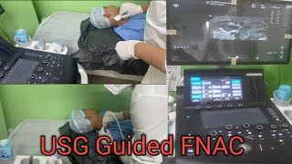 FNAC  Fine Niddle Aspiration Cytology  USG Guided FNAC  Procedure [upl. by Bendite]