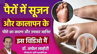 Leg Swelling amp Varicose Veins Your Treatment Options Explained By Dr Amol Lahoti [upl. by Yrtneg]