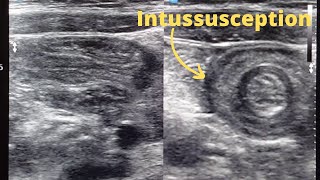 Intussusception  Ultrasound case II [upl. by Robby]