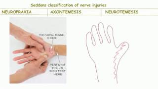 Seddons classification of nerve injurybackbenchers revolution [upl. by Erbma]