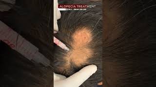 What Millenials Think About Alopecia Treatment  Viral shorts [upl. by Aiva]