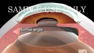 Diagnosis and Treatment of Closed Angle Glaucoma [upl. by Kaliski428]