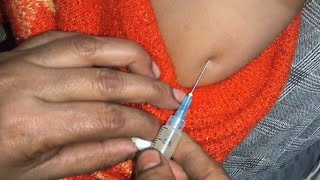 Im injection push  Intramural arms ceftriaxone Arixon 500 injection video 24 P31 by cannula 69 [upl. by Akeryt]