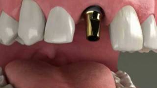 Dental Implants  Reasons to Replace Missing Teeth  Denville NJ [upl. by Nylrehs373]