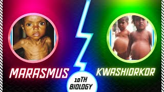 Marasmus and kwashiorkor nutritional deficiency diseases detailed explanation with pictures [upl. by Enneibaf399]