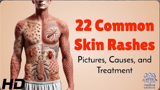 22 Skin Rashes Everyone Should Know About Symptoms amp Treatments [upl. by Cecily]