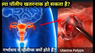 क्या पॉलीप खतरनाक हो सकता है गर्भाशय में पॉलीप्स क्यों होते हैं Uterine Polyps treatments [upl. by Eiahpets]