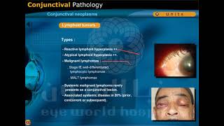 conjunctival neoplasms [upl. by Jenn251]