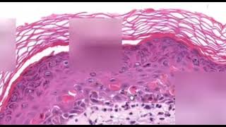 Erythema Multiforme Dermatopathology Easy learning [upl. by Dnilasor902]