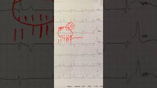 Hyperkalemia  Peaked TWaves  and ECG Recognition [upl. by Nahtaneoj]