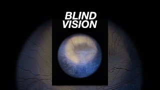 Blind Vision [upl. by Lyrej]