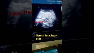 Fetal Heart Beat fetal bradycardia fetalultrasound fetal soundytshorts babyheartbeat [upl. by Ion]