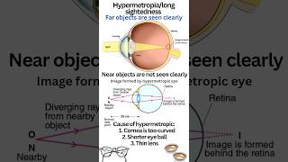 Far sightedness or hypermetropia class 10 class10 physics humaneye hypermetropia convexlens [upl. by Sewellyn536]