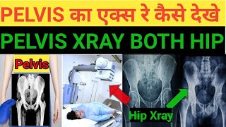 pelvis x ray kaise dekhe Techcpd pelvis x ray both hip कैसे देखे [upl. by Chaddy]