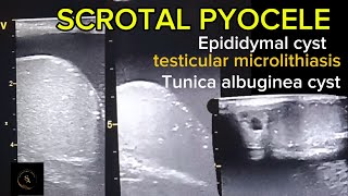 Complex hydroceleScrotal pyocele epididymal cyst testicular microlithiasis Tunica albuginea cyst [upl. by Yrro598]