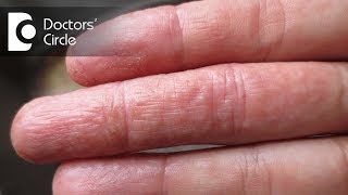 Difference between atopic dermatitis and eczema  Dr Rashmi Ravindra [upl. by Trocki285]