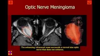 Orbit Intraconal Lesions V4b [upl. by Euqinobe]