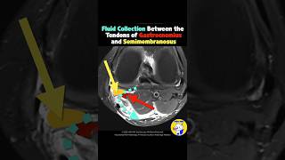 Fig 4D09 Ruptured Baker’s Cyst [upl. by Yentirb]