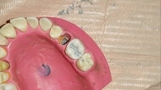 Amalgam restoration for maxillary first molar [upl. by Conlen]