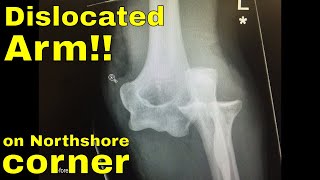 I fell off my mountain bike and dislocated my elbow [upl. by Ardnahsal]