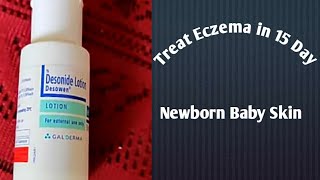 Desonide Lotion Treat Eczema in 15 Days for Newborn BabyToddler [upl. by Lein]