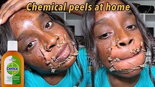 Homemade Chemical Peels That Are Guaranteed to Deliver Results [upl. by Kirad]