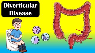 Diverticular Disease And Diverticulitis  Causes Signs amp Symptoms Diagnosis Treatment [upl. by Minetta]