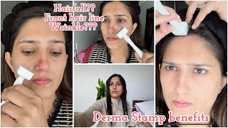 Derma stamp benefits for hair fall amp aging  Hairfall guide by Natasha waqas [upl. by Tempest]