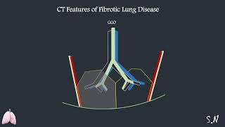 Central Role of CT in Management of Pulmonary Fibrosis dr Sara Nasr [upl. by Bergeman]