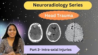 Intraaxial Injuries  Head Trauma Part 3  Neuroradiodiology  Dr Somlina Dutta [upl. by Kirat113]