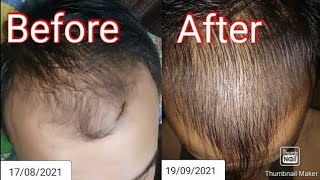 monoxide hair growth results after 3 months part3 [upl. by Emina]