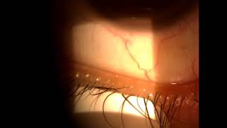 Meibomian Gland Expression Video [upl. by Ameerak]