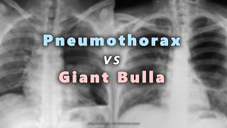 Pneumothorax vs Giant Bulla in Chest X Ray Part 6 [upl. by Eeliak]